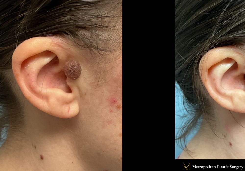 Before and after Non-surgical Facial Rejuvenation case 23847