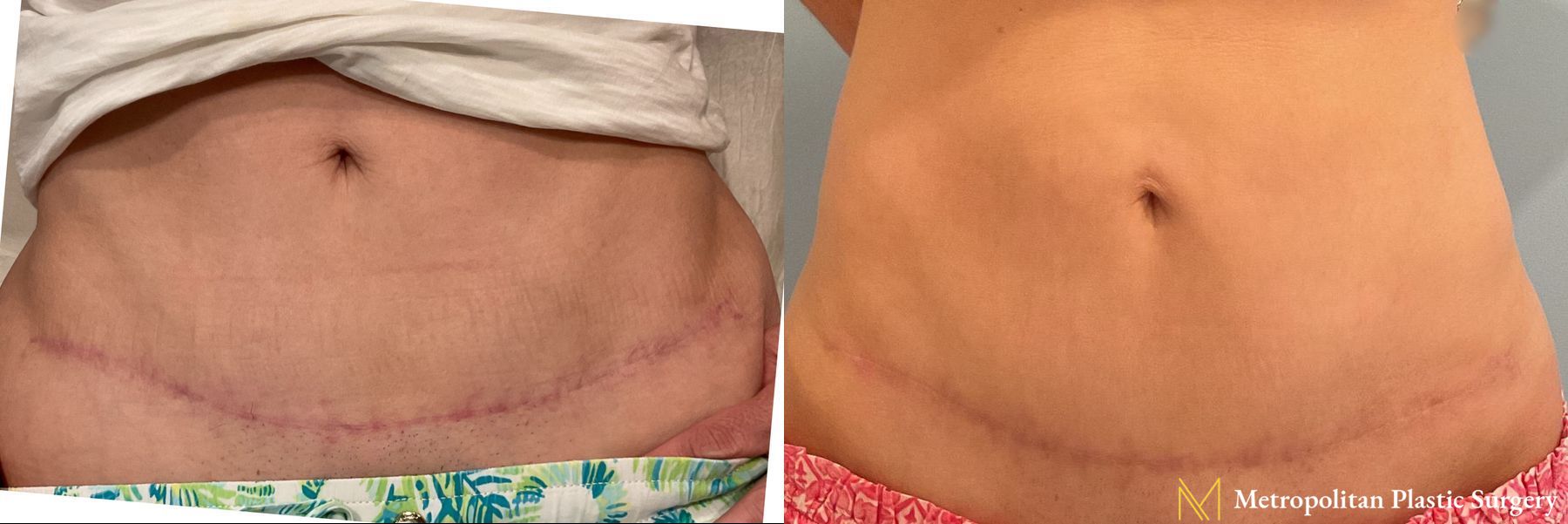 Before and after Scar Management case 41729