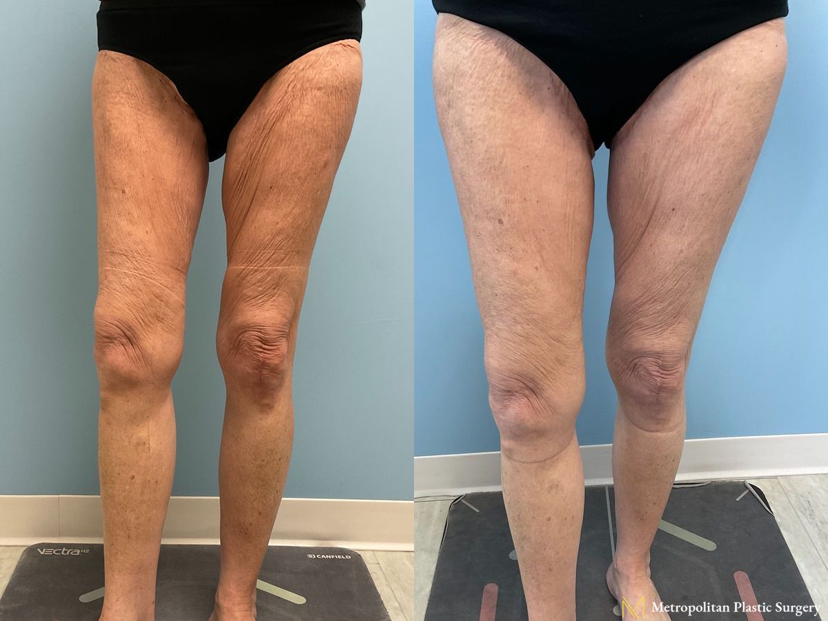 Thigh Lift performed by Dr. Julia Spears