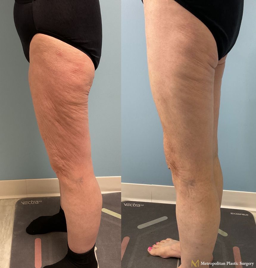 Thigh Lift with Liposuction of Thighs and Calves performed by Dr. Julia Spears - Angle 3