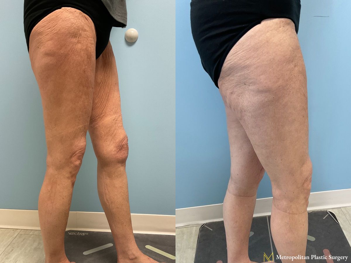 Thigh Lift performed by Dr. Julia Spears - Angle 3