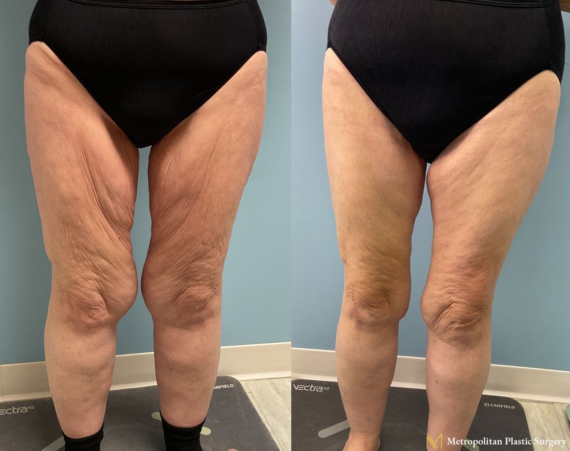 Thigh Lift with Liposuction of Thighs and Calves performed by Dr. Julia Spears