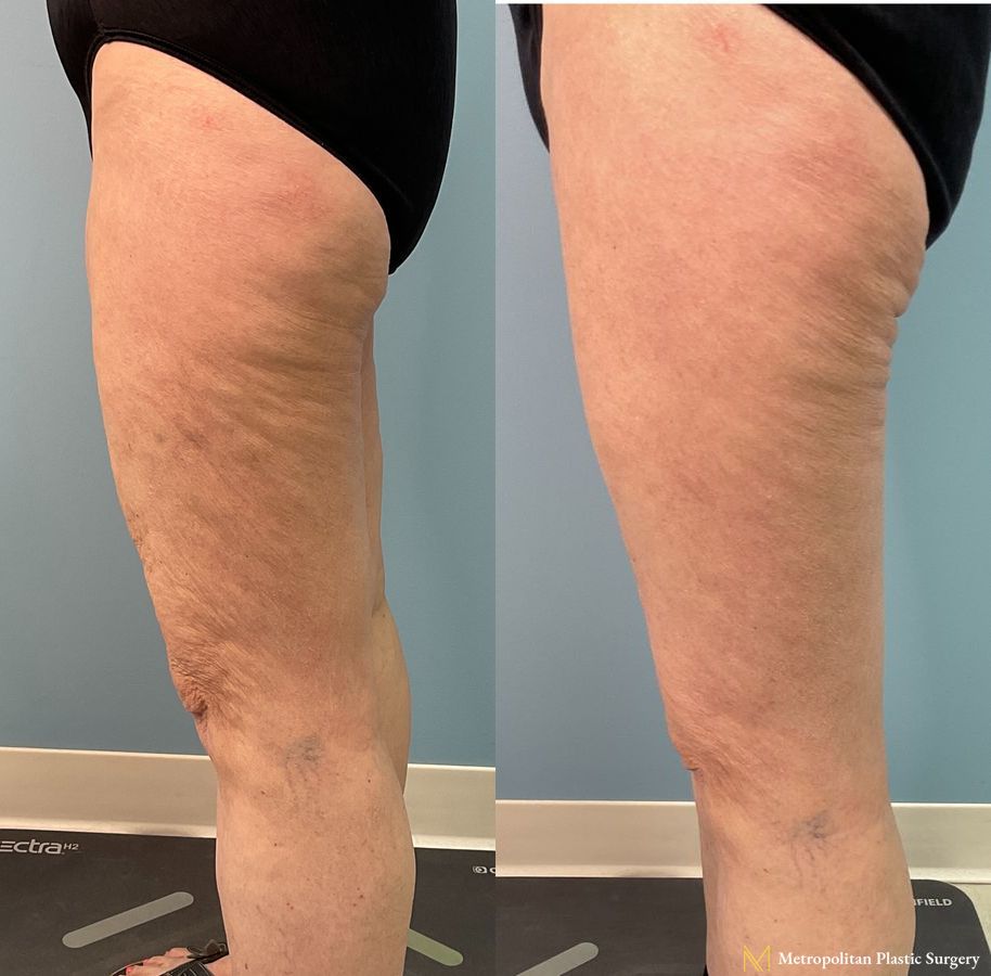 Before and after Thigh Lift case 23984 - Angle 3