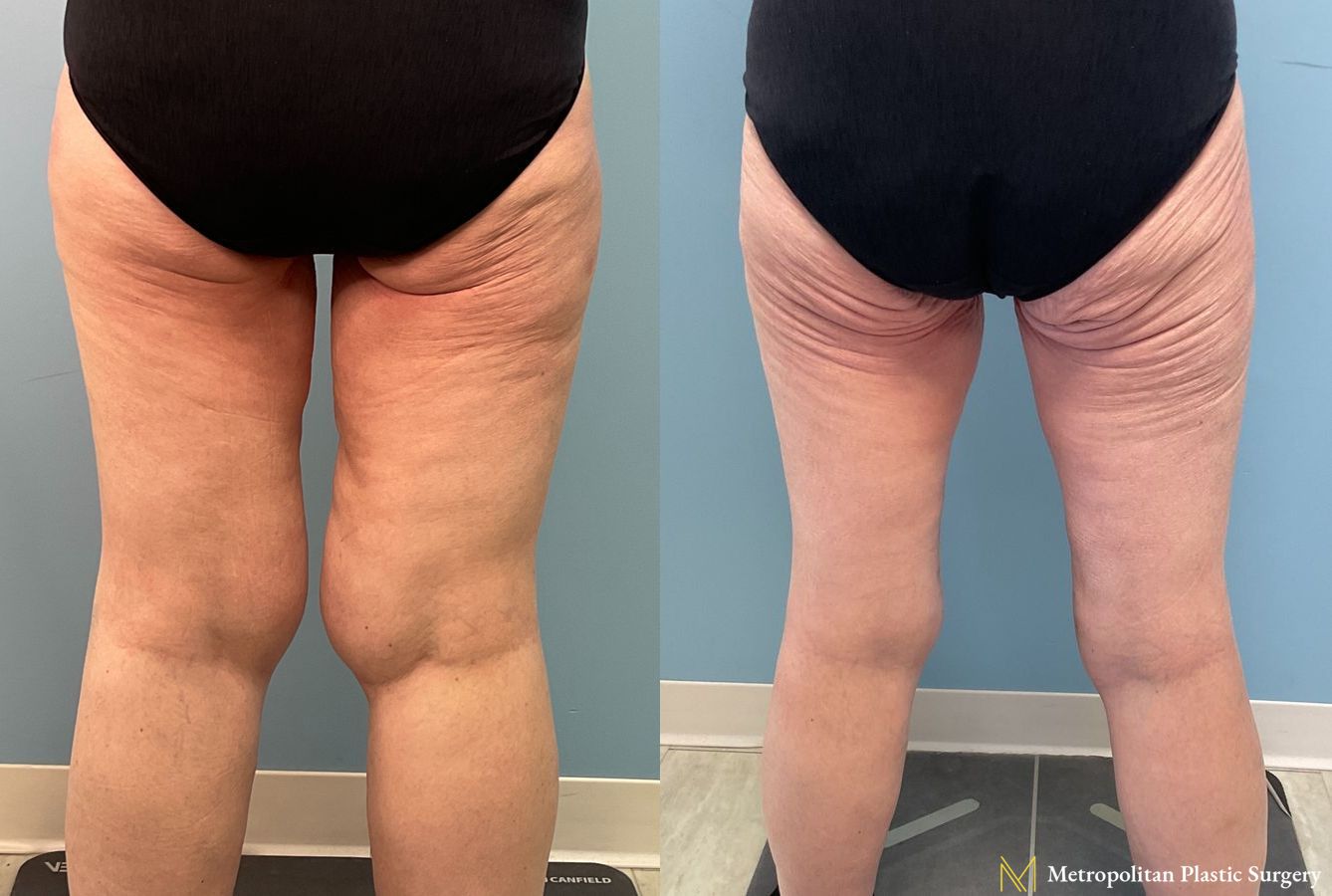Before and after Liposuction case 23984 - Angle 3