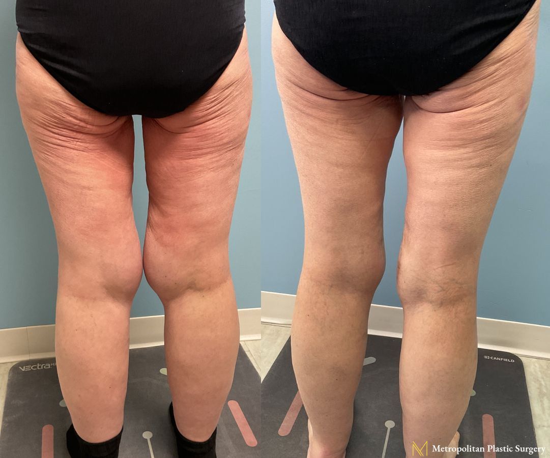 Thigh Lift with Liposuction of Thighs and Calves performed by Dr. Julia Spears - Angle 4