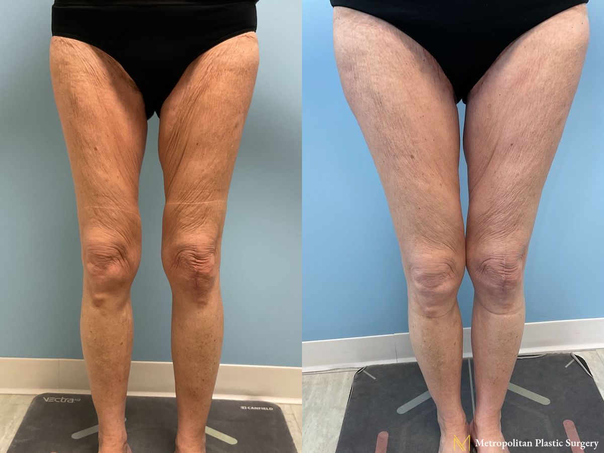 Thigh Lift performed by Dr. Julia Spears - Angle 2