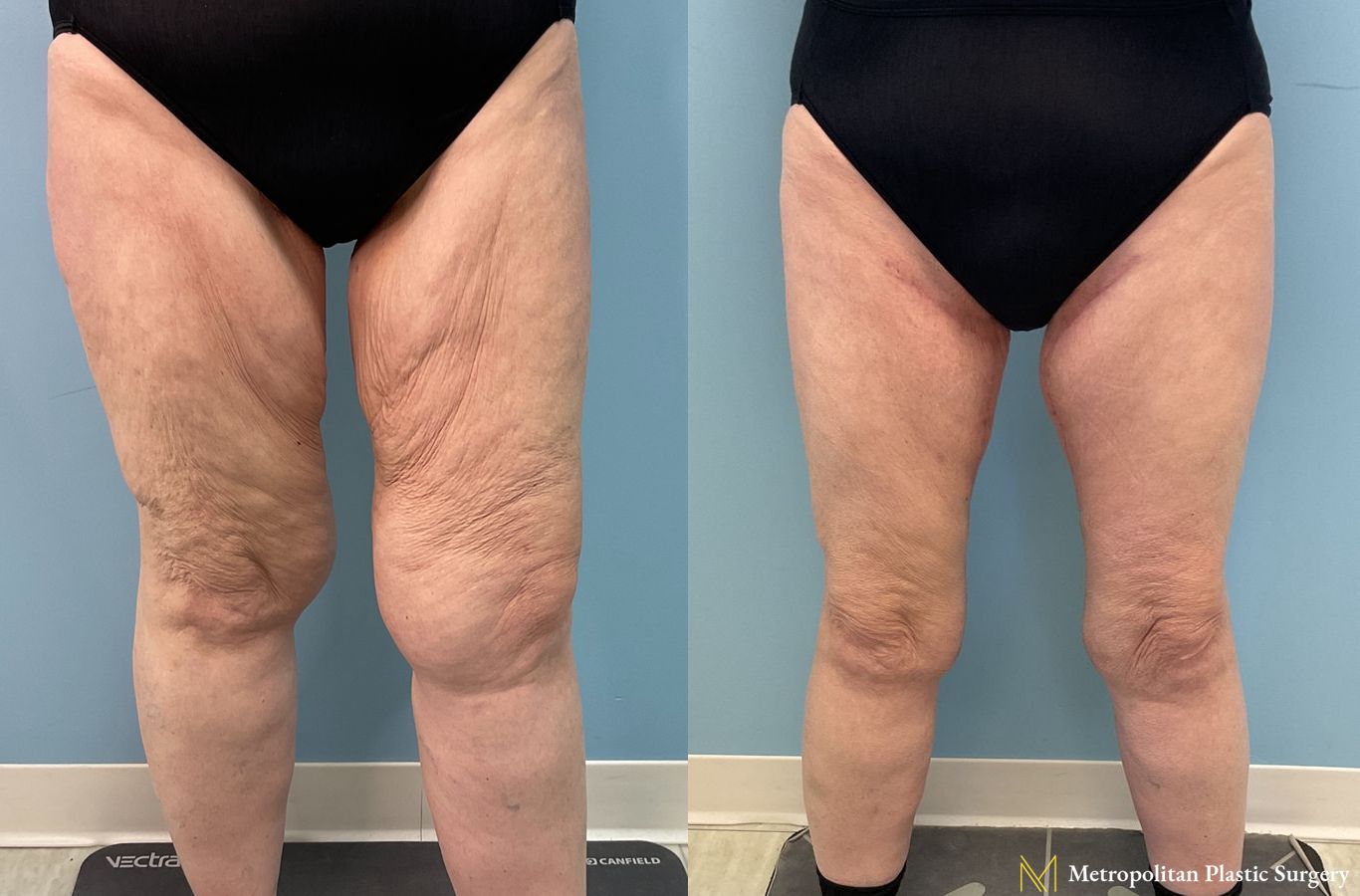 Before and after Liposuction case 23984