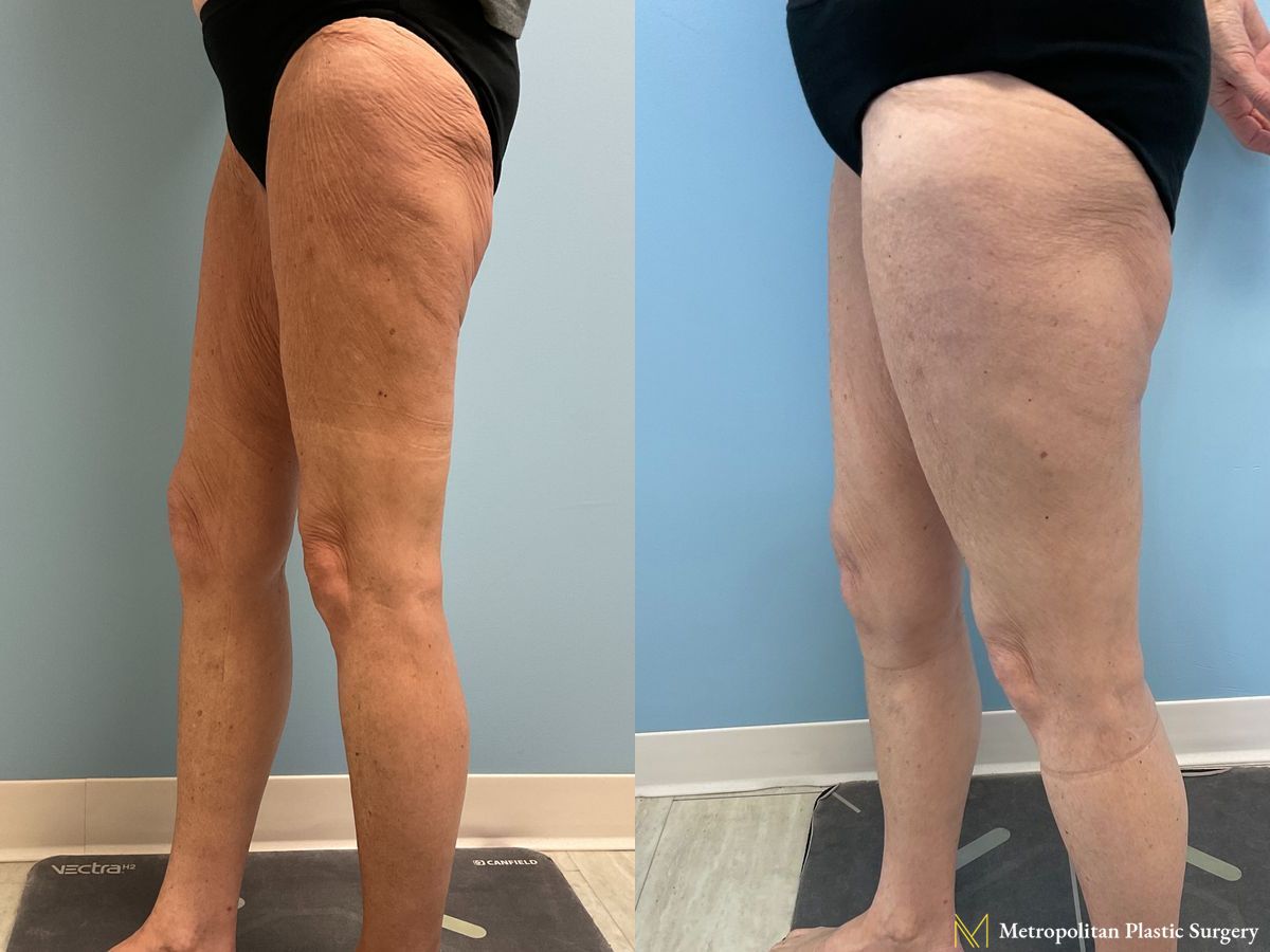 Thigh Lift performed by Dr. Julia Spears - Angle 4