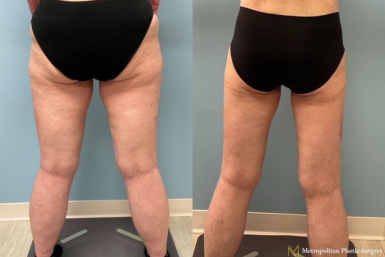 Thigh Lift performed by Dr. Julia Spears - Angle 2