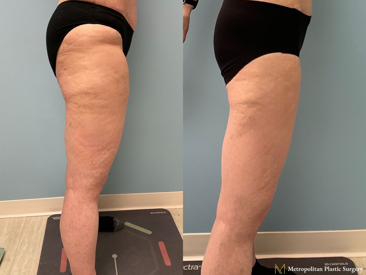 Thigh Lift performed by Dr. Julia Spears - Angle 3