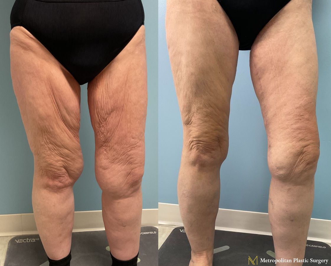 Thigh Lift with Liposuction of Thighs and Calves performed by Dr. Julia Spears - Angle 2