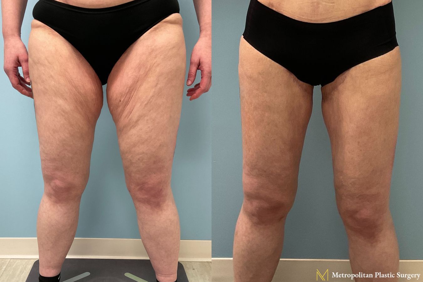 Thigh Lift performed by Dr. Julia Spears