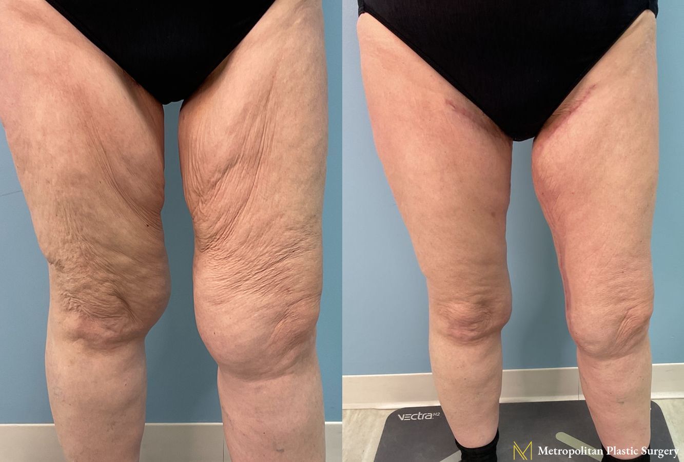 Before and after Thigh Lift case 23984 - Angle 2