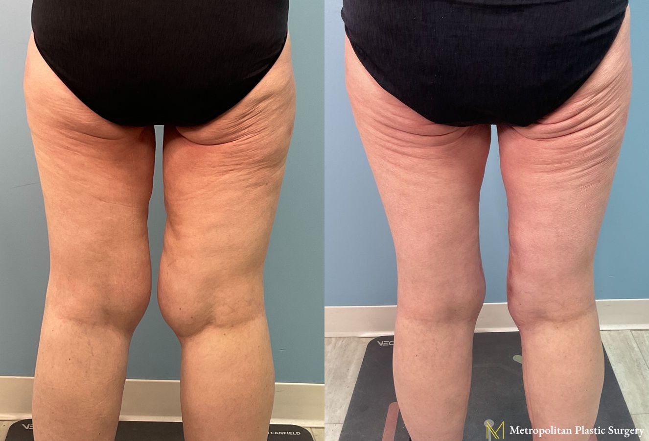 Before and after Thigh Lift case 23984 - Angle 4
