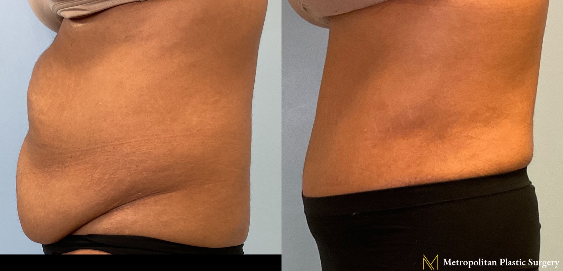Tummy Tuck performed by Dr. Julia Spears - Angle 2