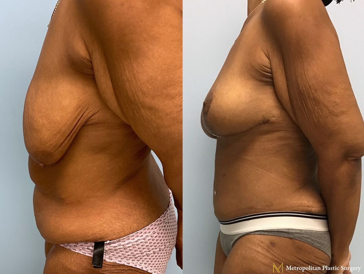 Before and after Tummy Tuck case 7999 - Angle 5