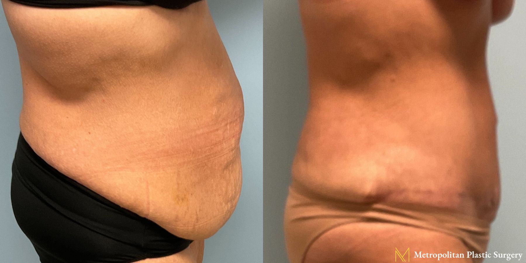 Before & after abdominoplasty photos for abdominoplasty - Angle 2