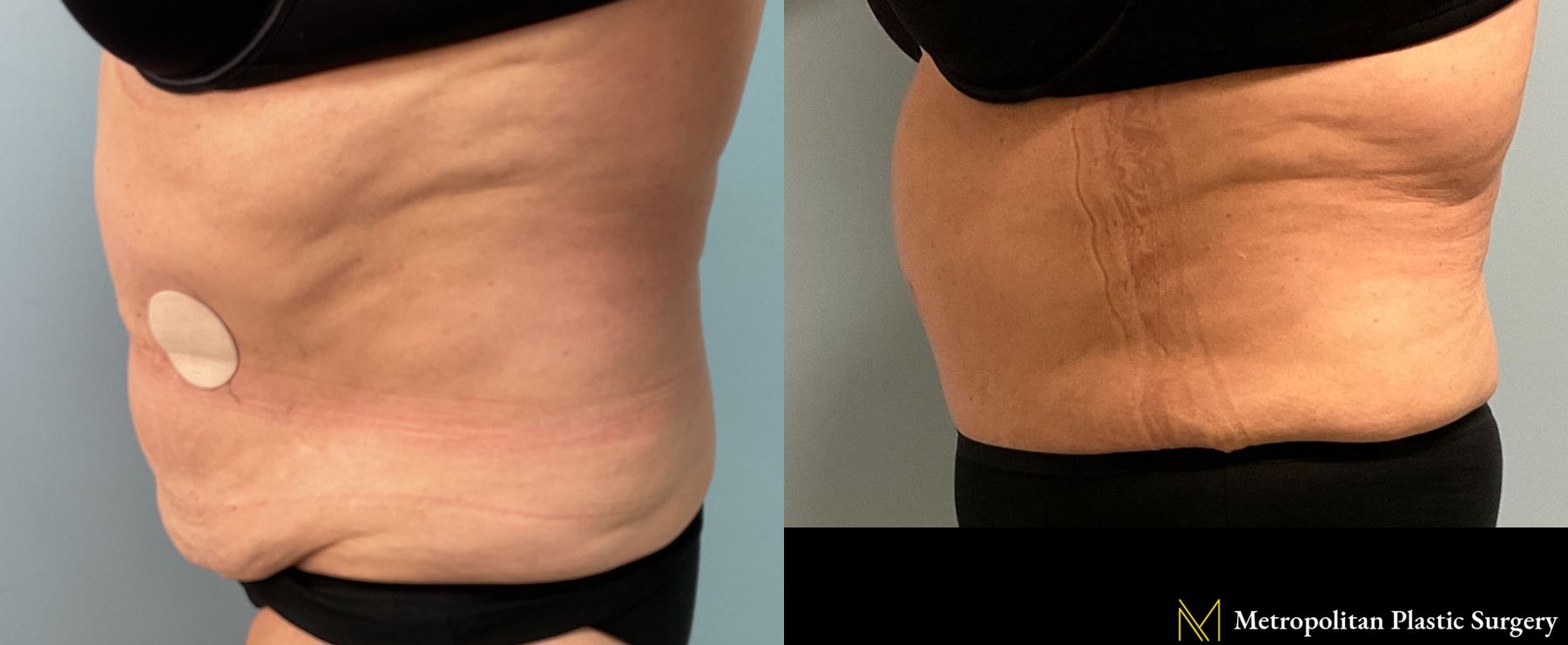 Tummy Tuck performed by Dr. Julia Spears