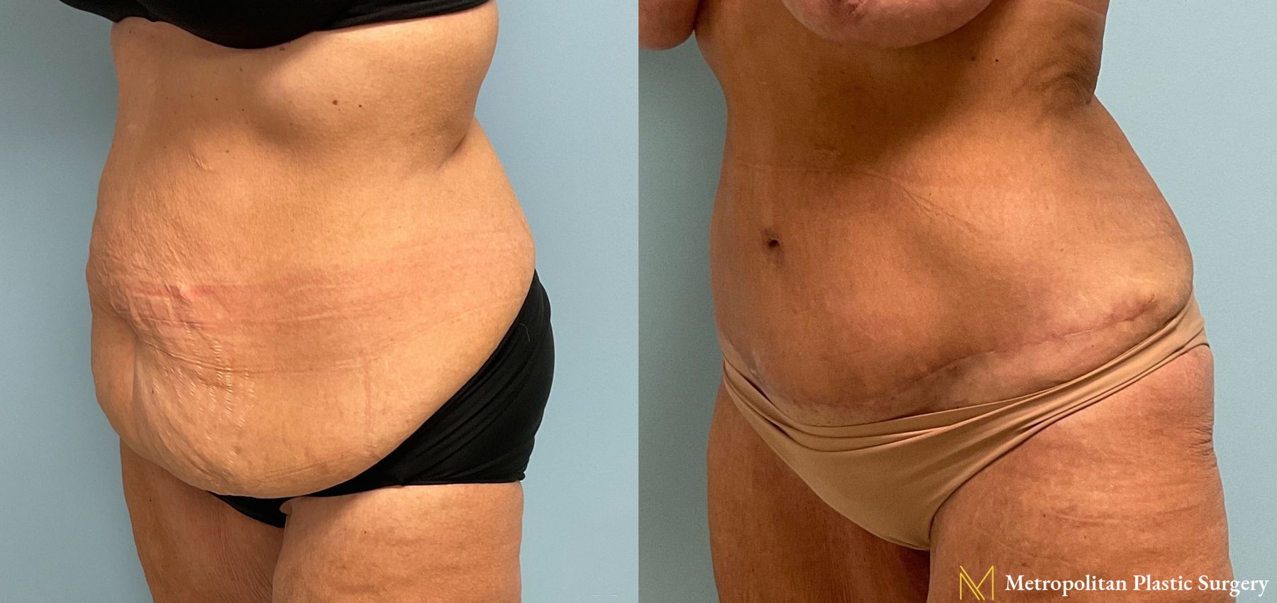 Before and after Tummy Tuck case 8039 - Angle 4