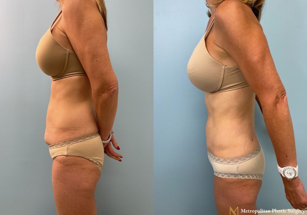 Liposuction - Thumbnail 3