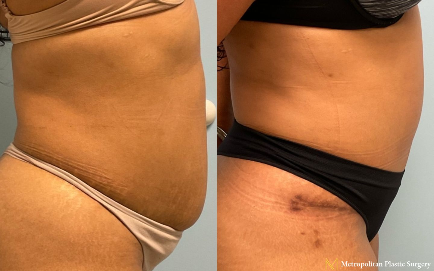 Before & after abdominoplasty photos for abdominoplasty - Angle 2