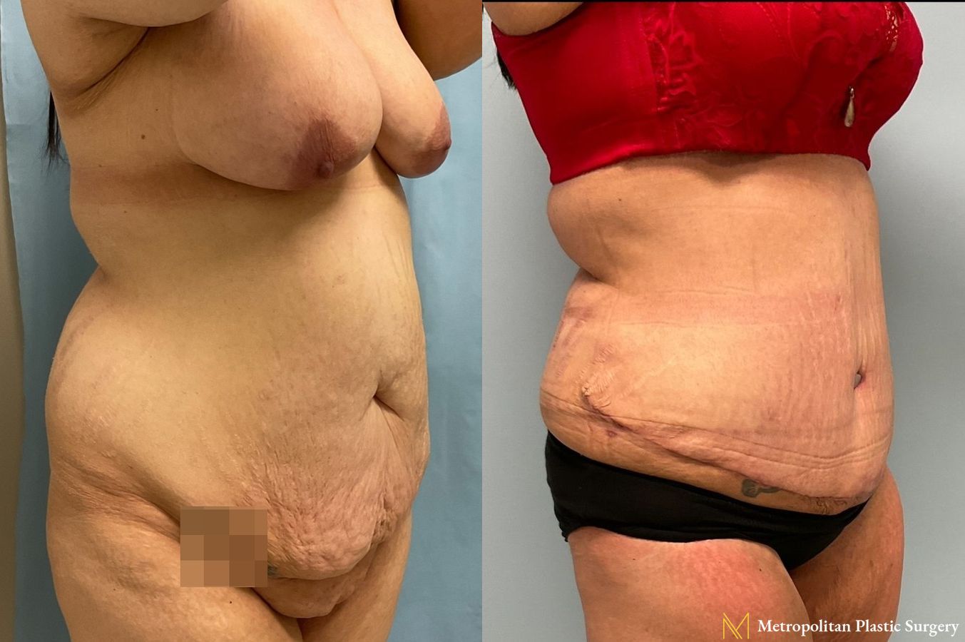 Before and after Tummy Tuck case 8051 - Angle 2