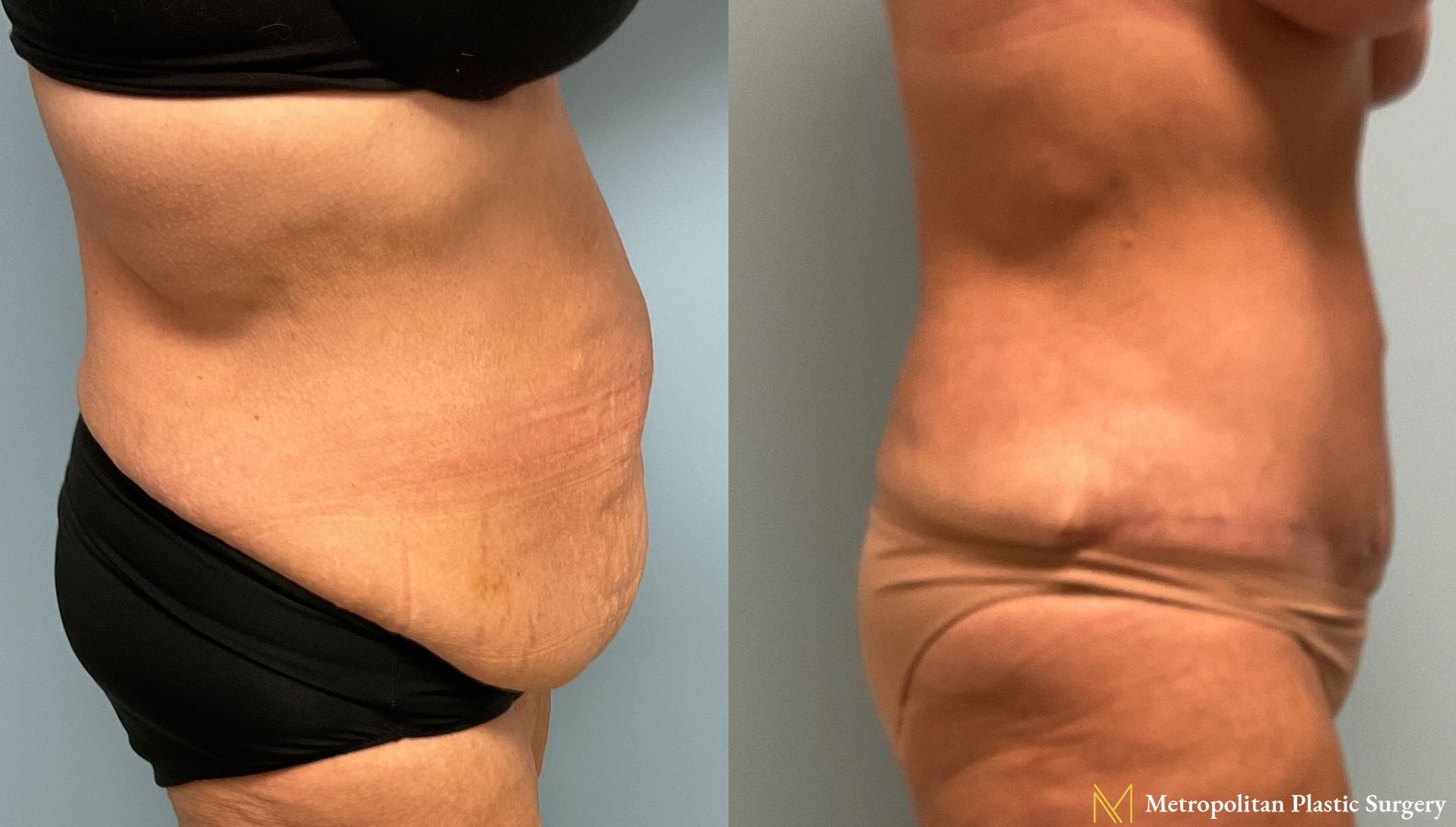 Before and after Tummy Tuck case 8039 - Angle 2