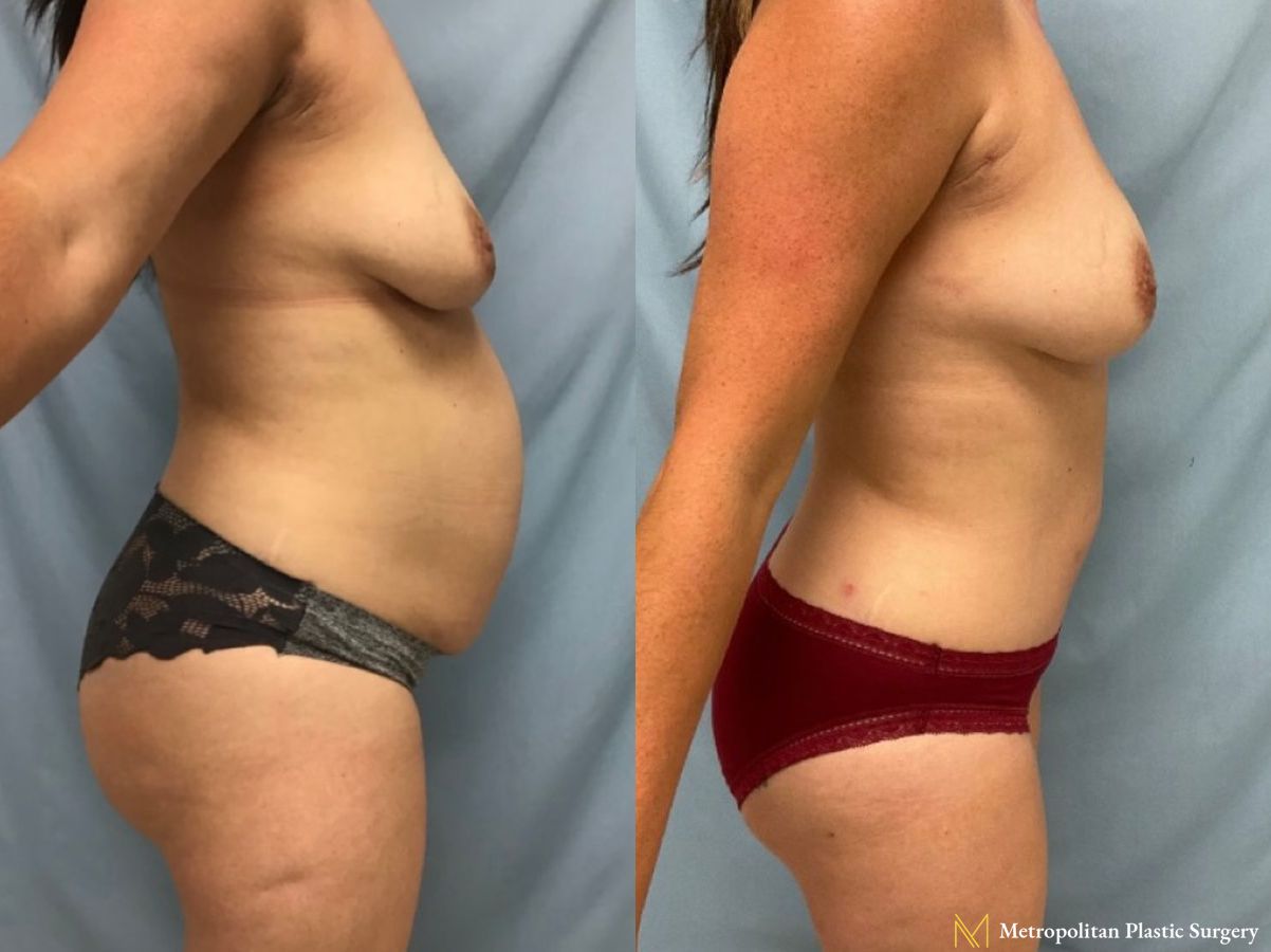 Before and after Liposuction case 17401 - Angle 2