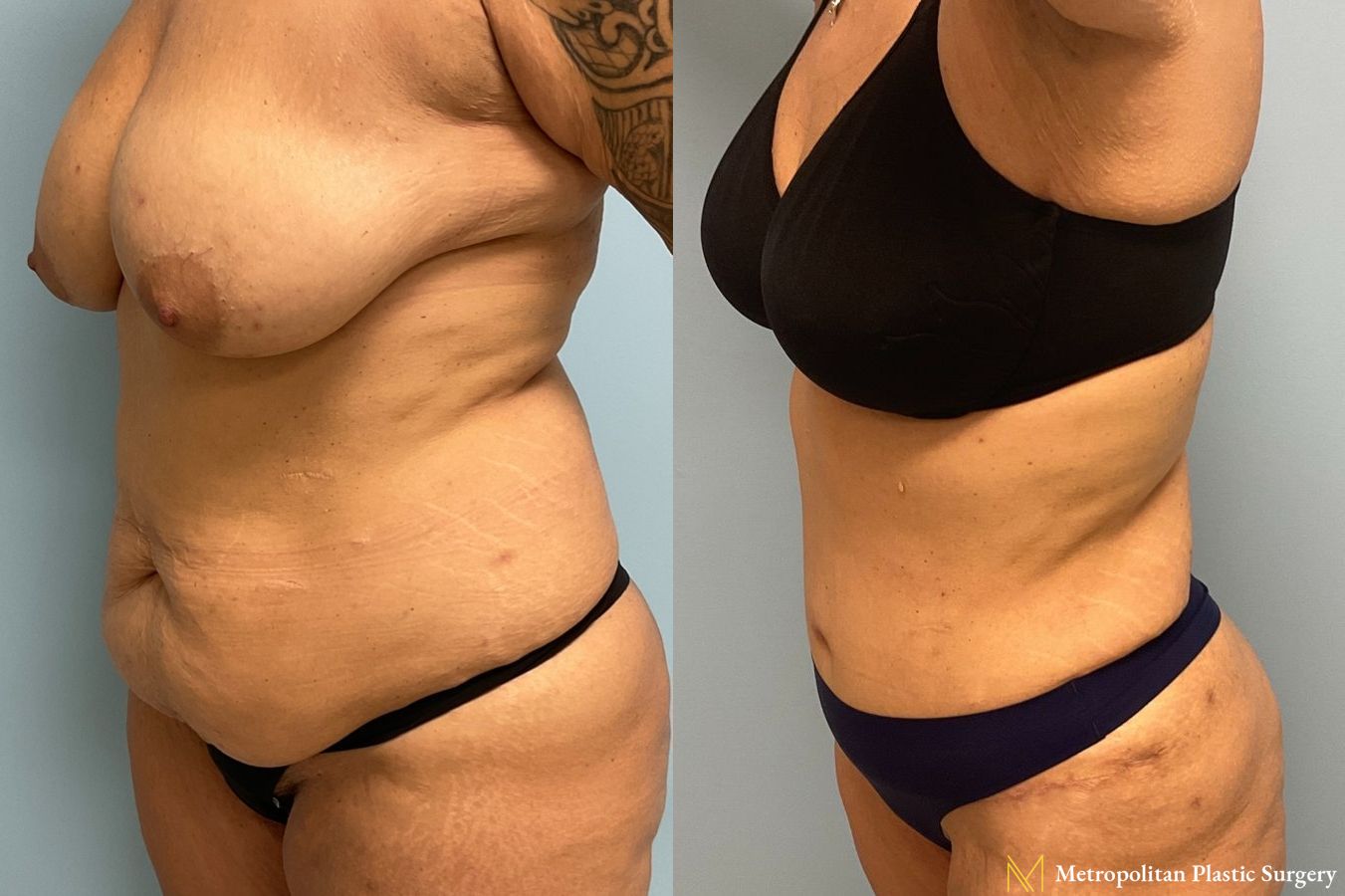 Before and after Tummy Tuck case 8020 - Angle 5