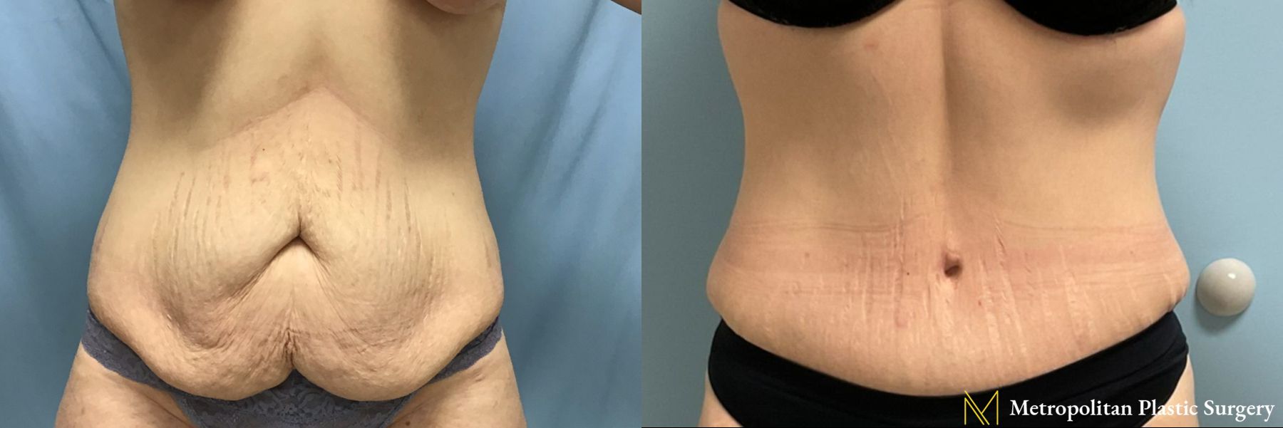 Tummy Tuck performed by Dr. Julia Spears