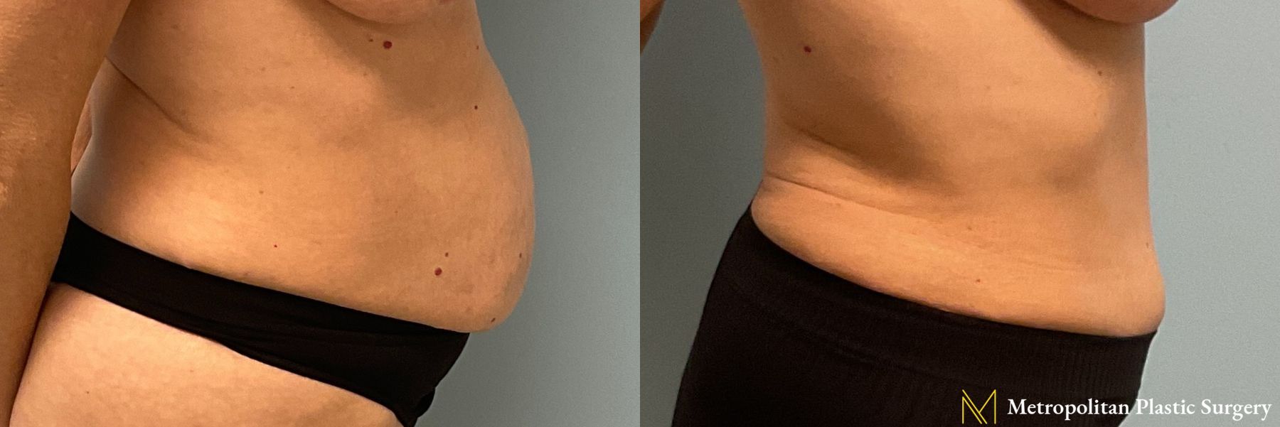 Tummy Tuck performed by Dr. Julia Spears - Angle 3
