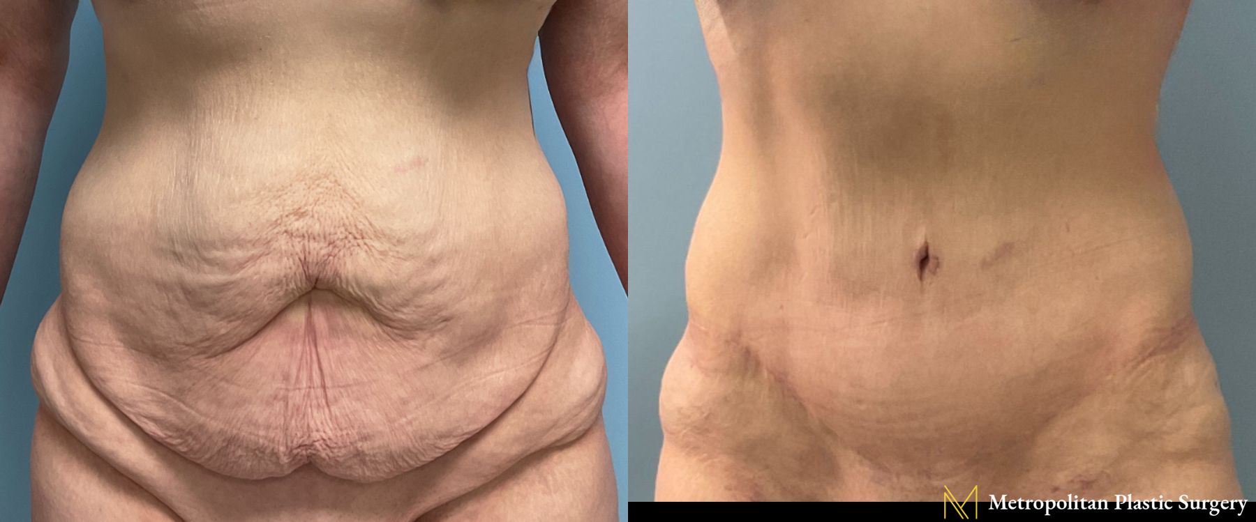 Tummy Tuck performed by Dr. Julia Spears at Metropolitan Plastic Surgery