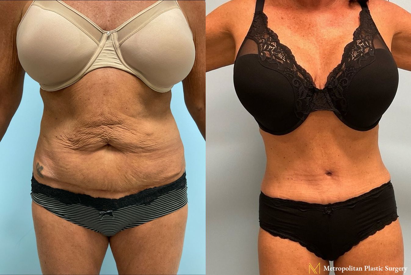 Before and after Tummy Tuck case 8085