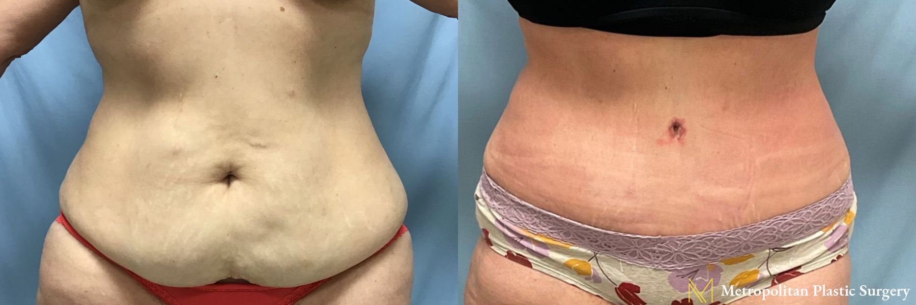 Before and after Liposuction case 21657