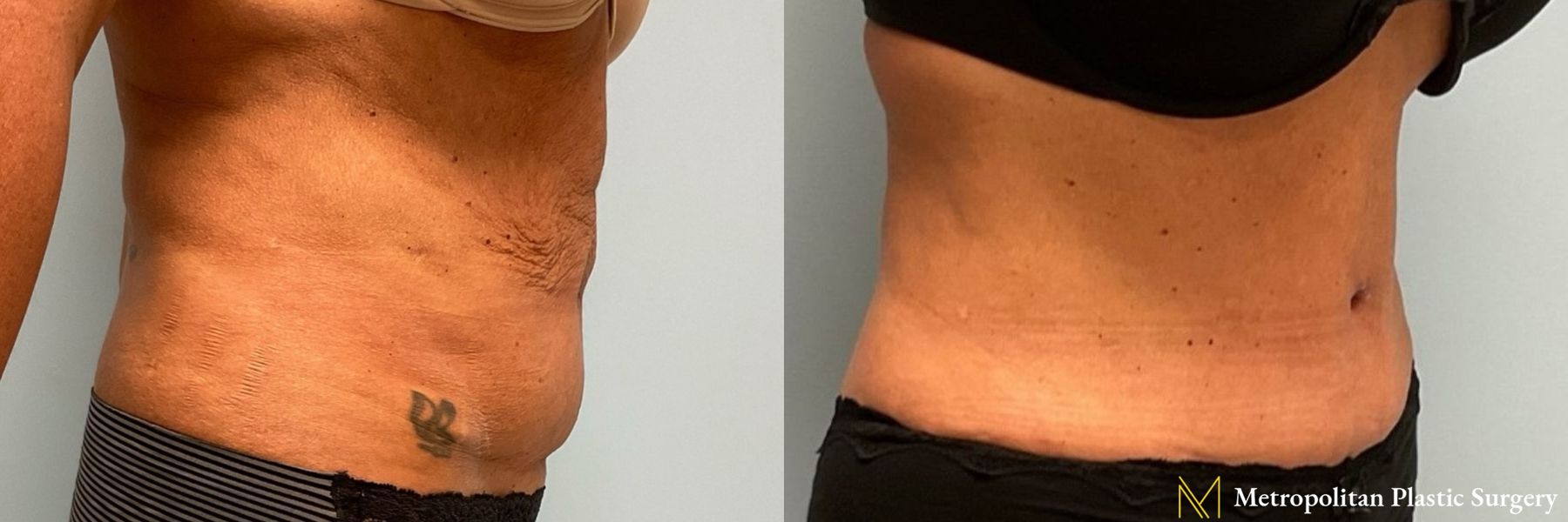 Before & after abdominoplasty photos for abdominoplasty - Angle 2