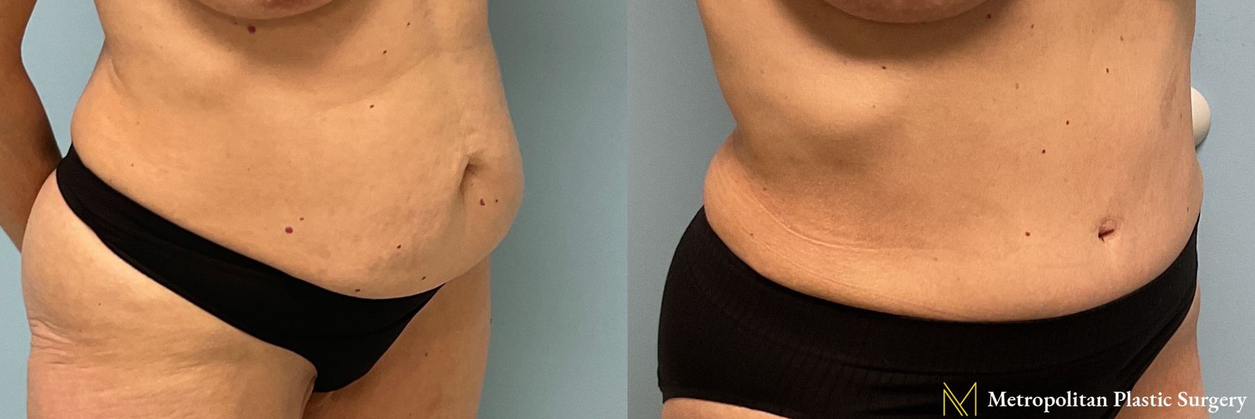 Tummy Tuck performed by Dr. Julia Spears - Angle 2