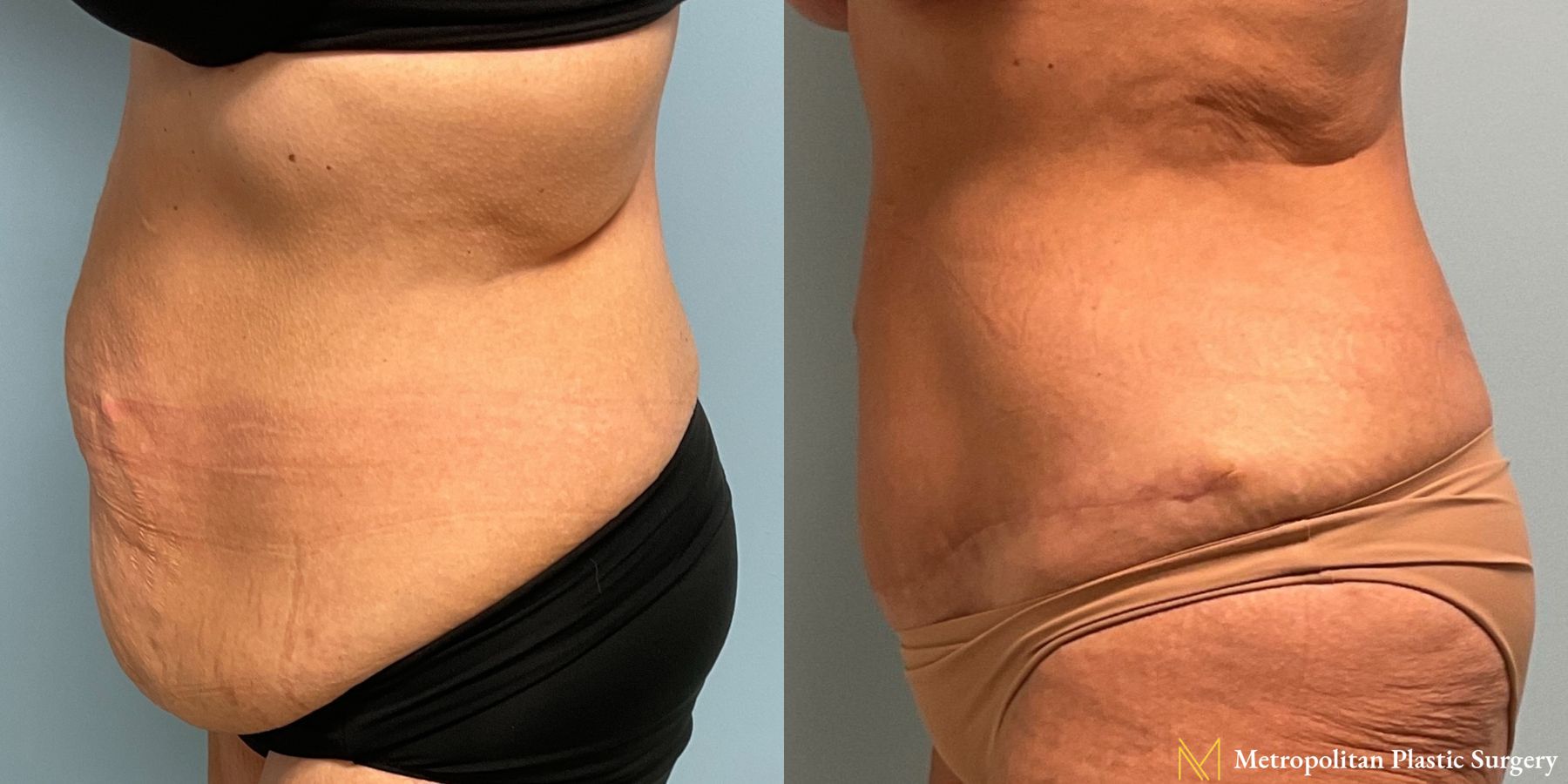 Before & after abdominoplasty photos for abdominoplasty - Angle 3