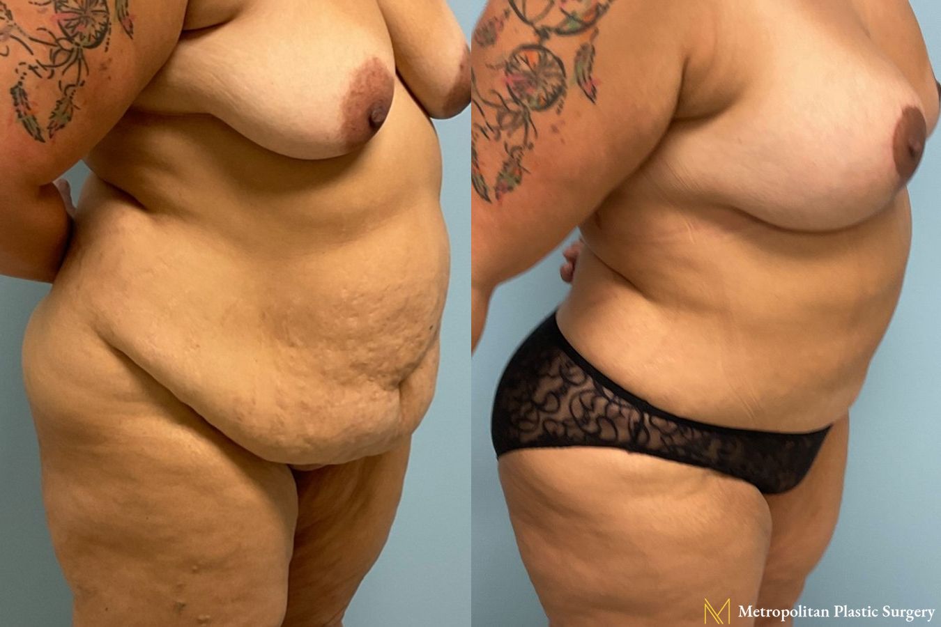 Before and after Tummy Tuck case 8052 - Angle 3