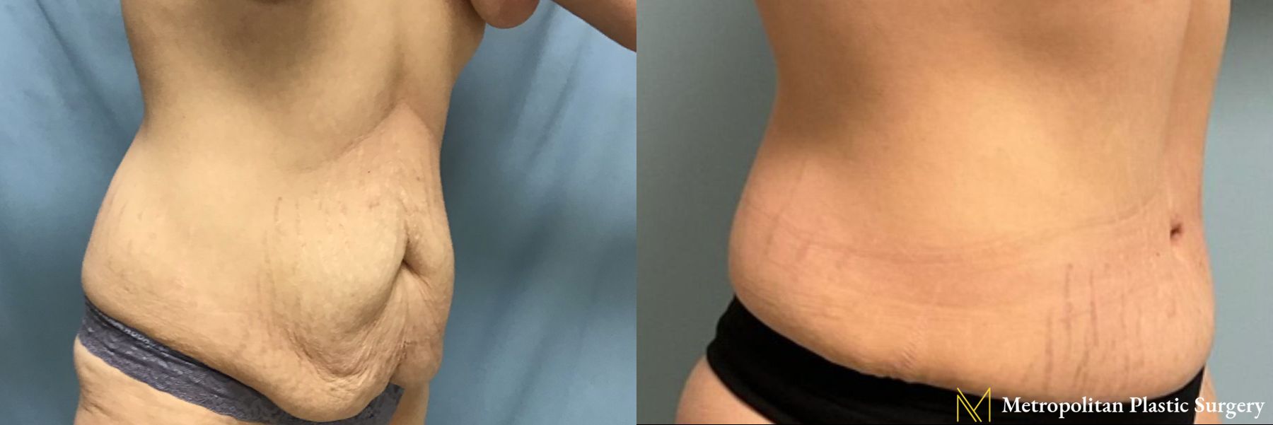 Tummy Tuck performed by Dr. Julia Spears - Angle 3
