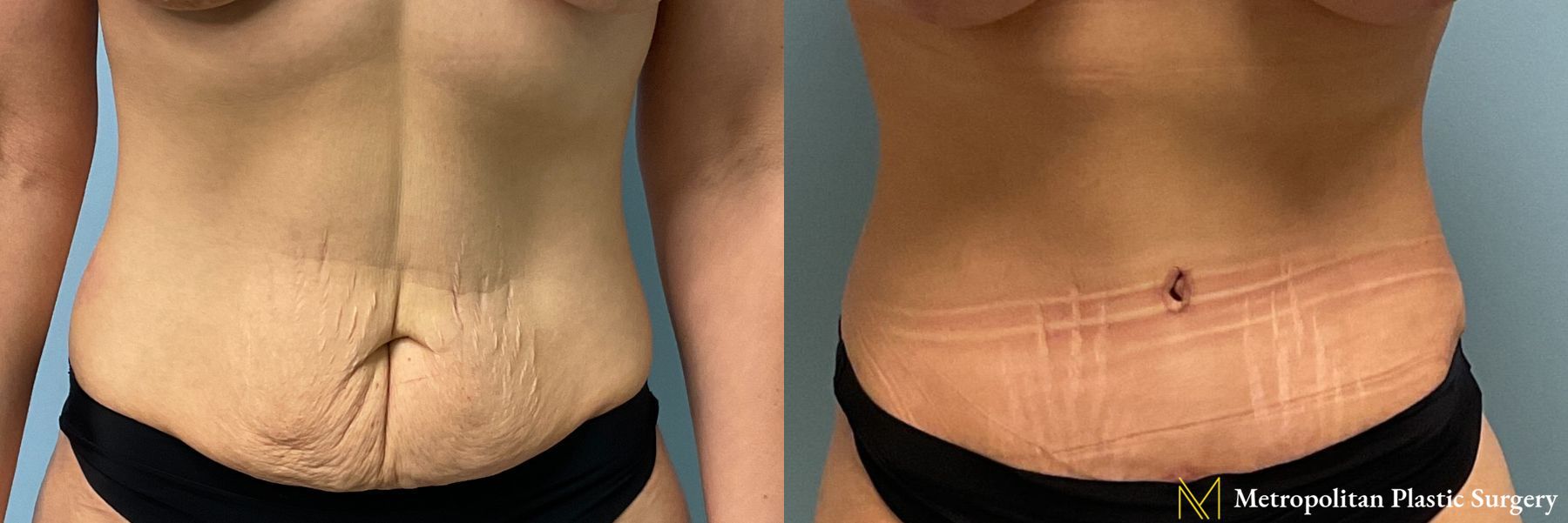 Tummy Tuck performed by Dr. Julia Spears