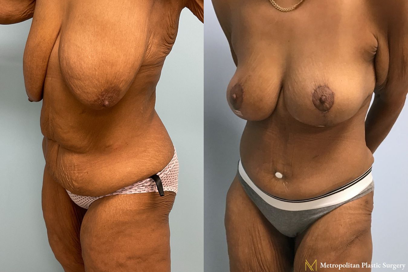 Before and after Tummy Tuck case 7999 - Angle 4