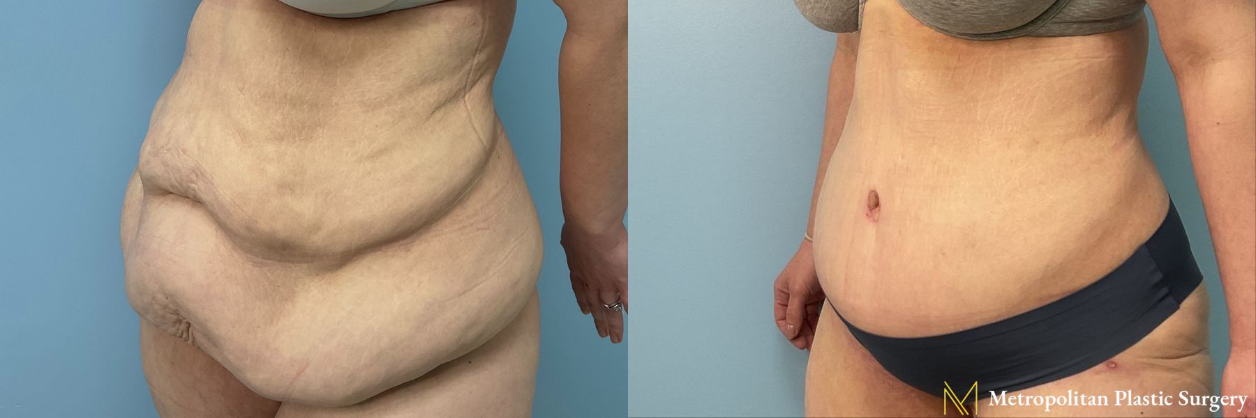 Before and after Tummy Tuck case 13185 - Angle 2