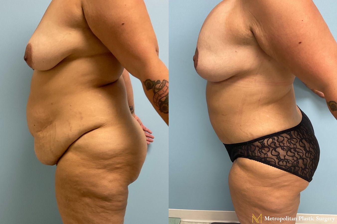 Before and after Tummy Tuck case 8052 - Angle 5