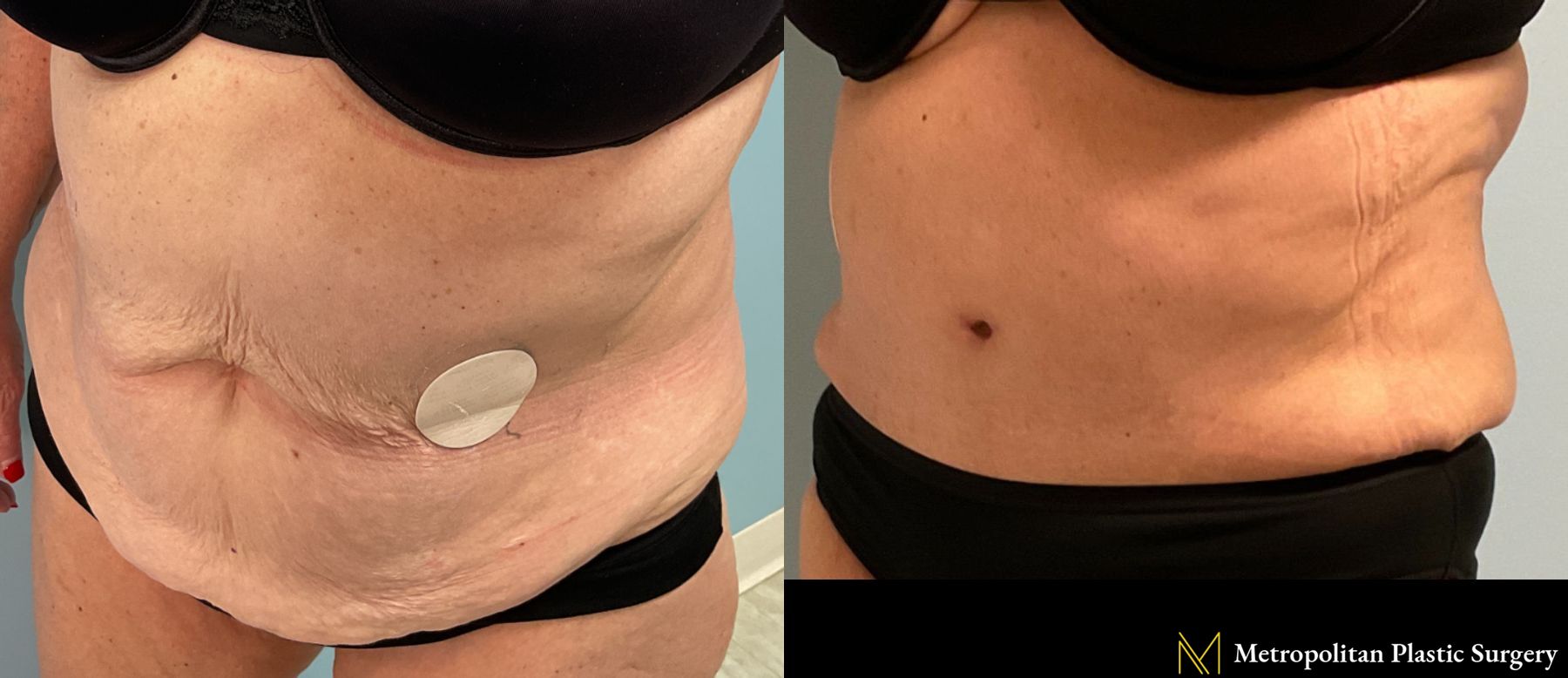 Tummy Tuck performed by Dr. Julia Spears - Angle 3