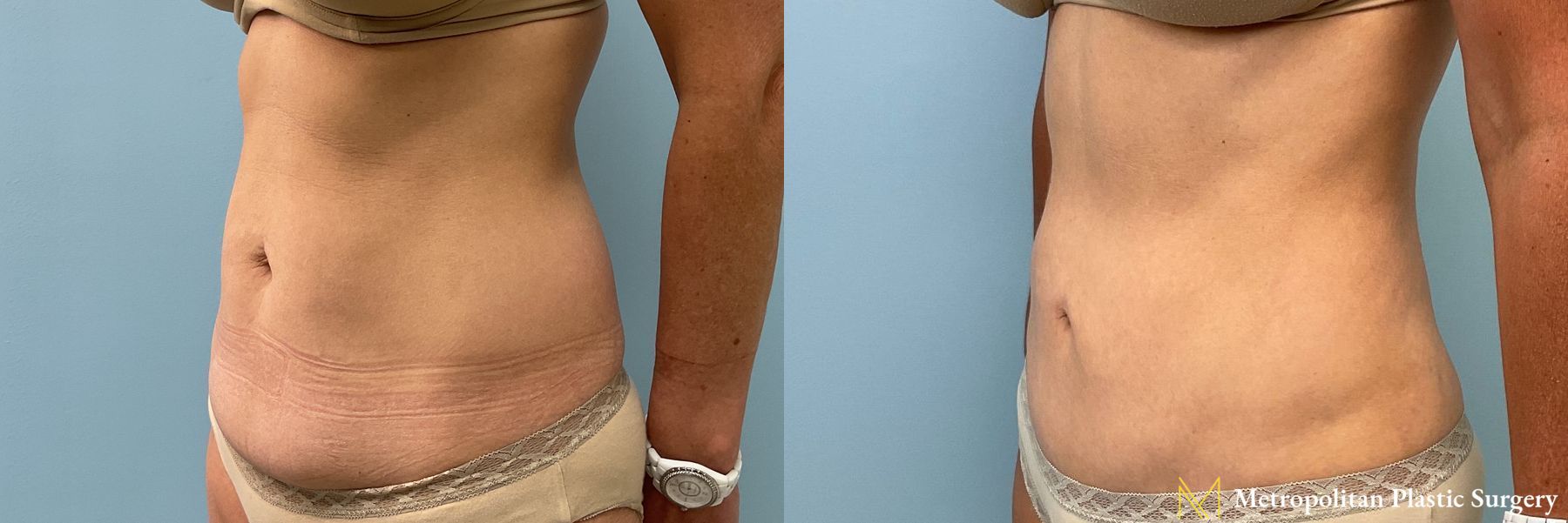 Before and after Tummy Tuck case 23849 - Angle 2