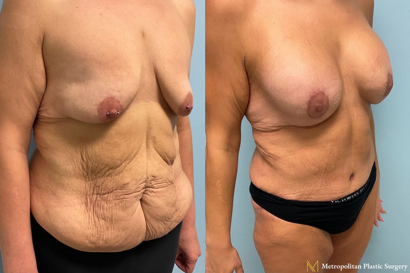 Before and after Tummy Tuck case 8044 - Angle 5