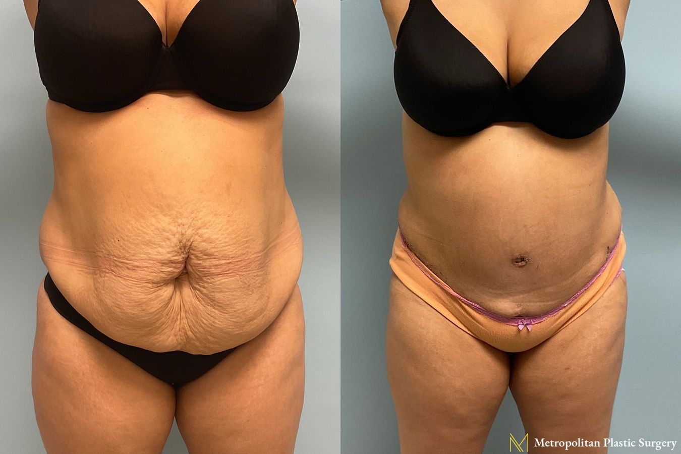 Before and after Tummy Tuck case 8041