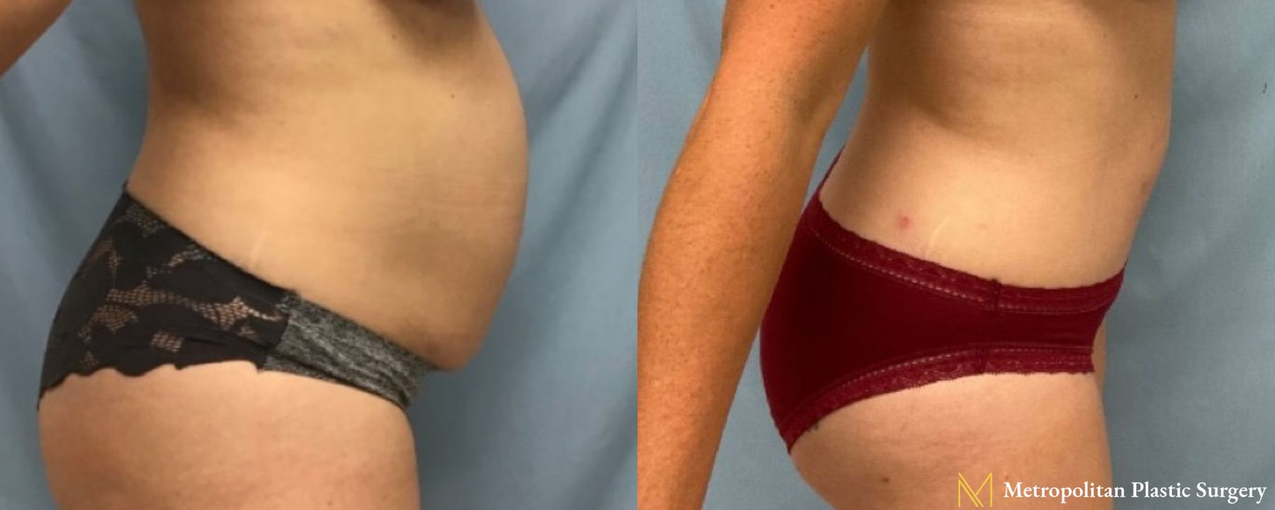Before and after Tummy Tuck case 41785 - Angle 2