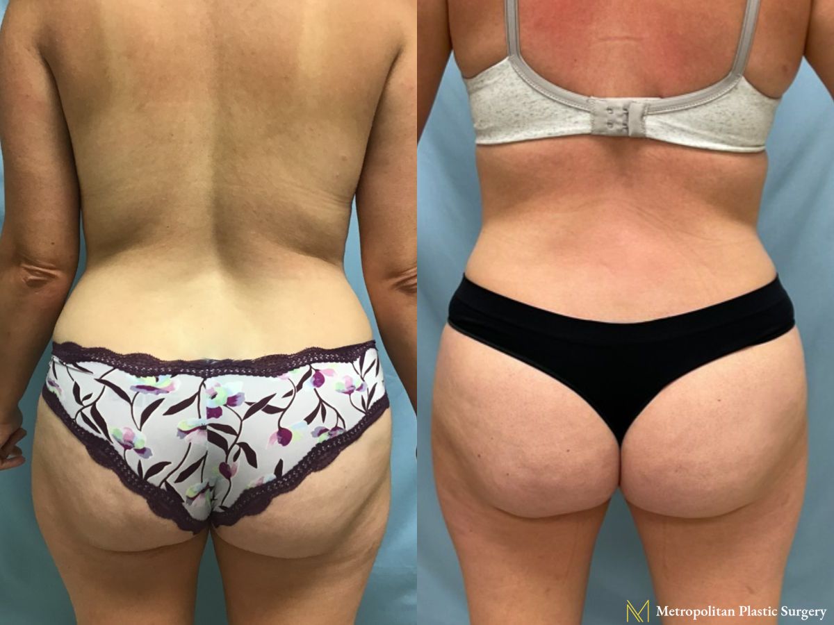 Before and after Liposuction case 17401 - Angle 3