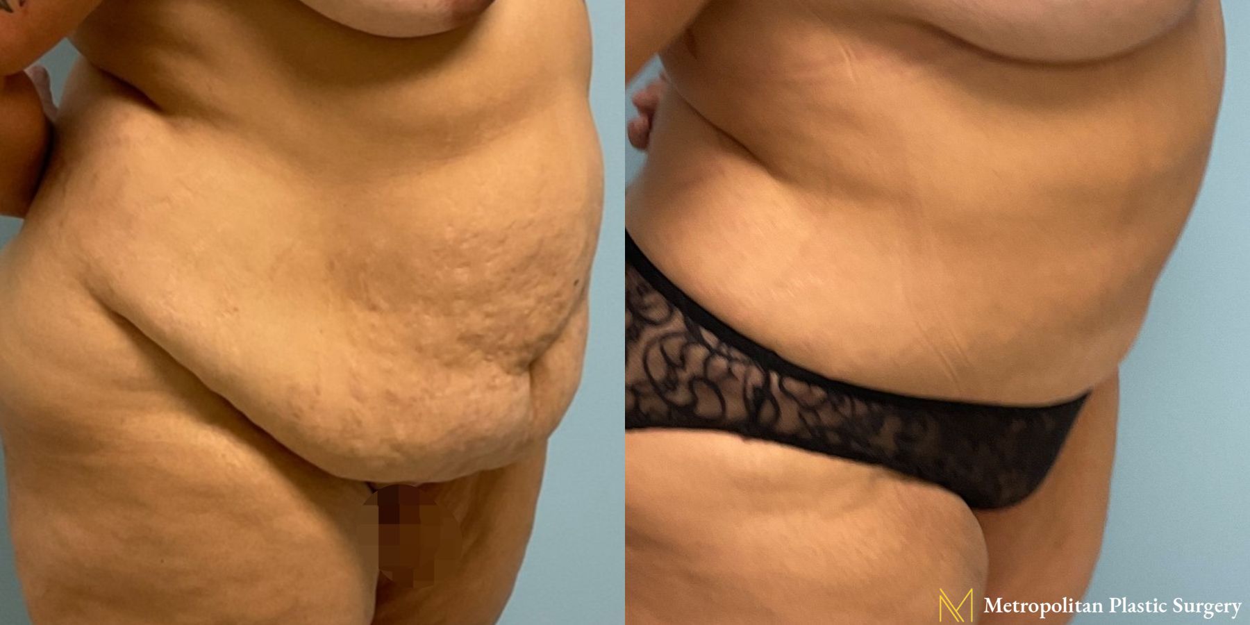 Before and after Tummy Tuck case 8052 - Angle 3